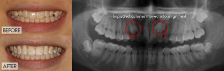 Adult Treatment - impacted canines